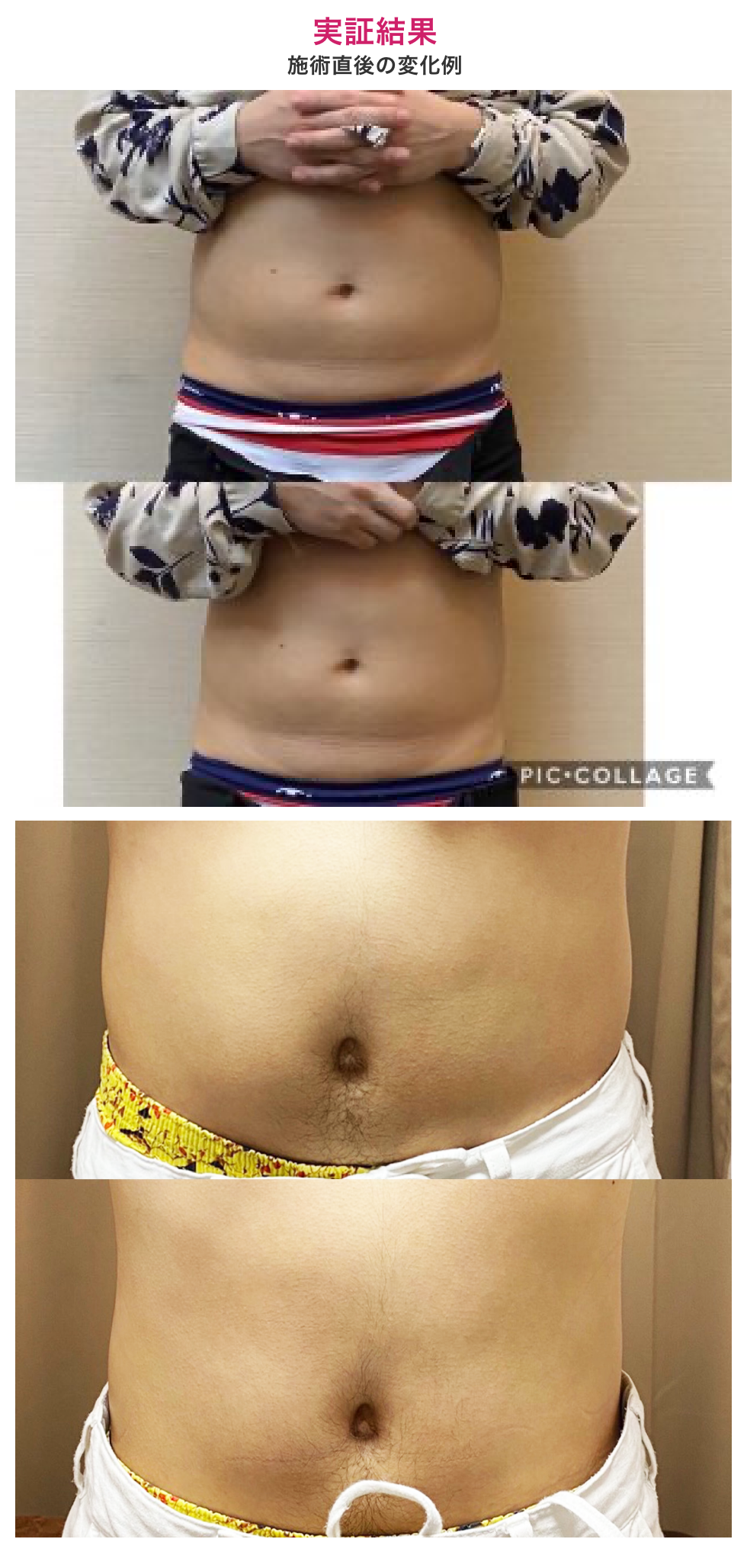実証結果：施術直後の変化例腹部の比較写真